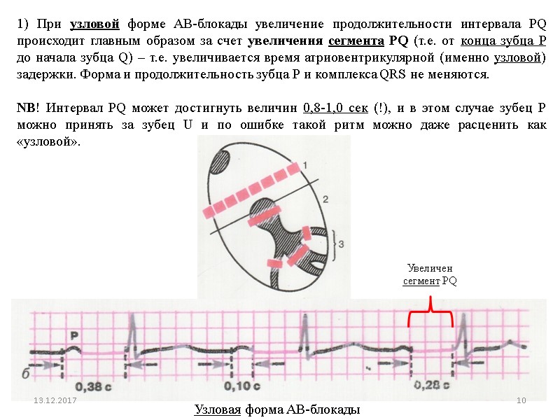 1) При узловой форме АВ-блокады увеличение продолжительности интервала PQ происходит главным образом за счет